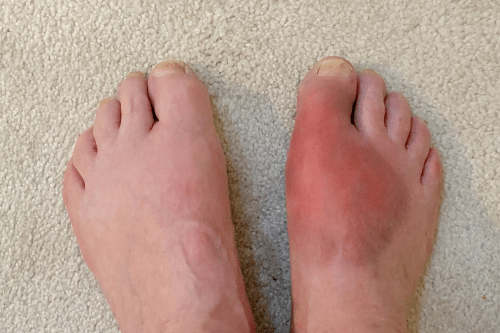 How do purines affect gout?